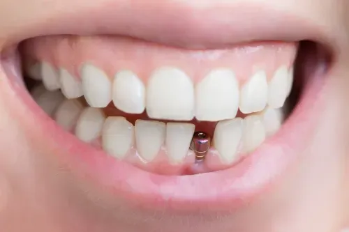 Enozobni implantat v estetski coni